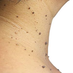 Skin Tags and Moles Removal 6 to 10 lesions