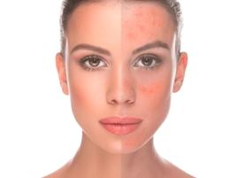 Rosacea Phototherapy  