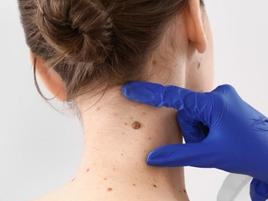 Skin Tag and Mole Removal 1 to 5 Tags and Moles